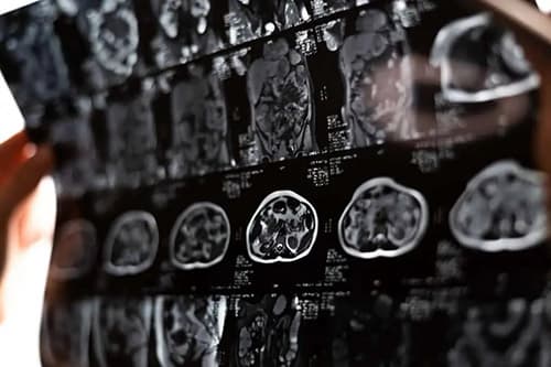 Brain Injury Lawyers in St. Louis
